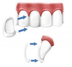 illustration of veneers being placed over front of top teeth, veneers New Baltimore, MI cosmetic dentistry