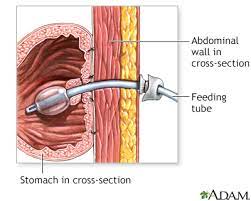 feeding insertion gastrostomy