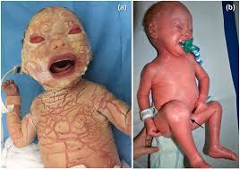 Bland sutton med chir trans. Juvenile Idiopathic Arthritis In Infant With Harlequin Ichthyosis