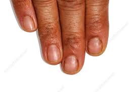white lines on fingernails stock