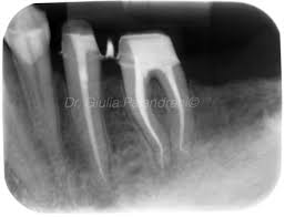 endodontically treated teeth