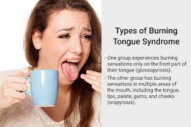 relieve burning tongue syndrome