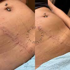 inkless stretch mark revision training