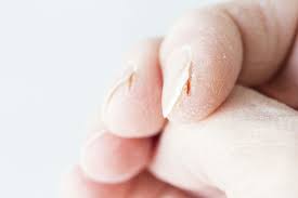 skin fissures and split fingertips