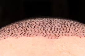 hair transplant scabs vera clinic