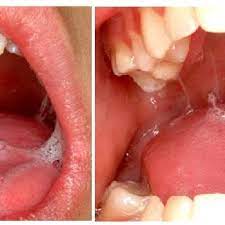 sticky saliva see the clinical
