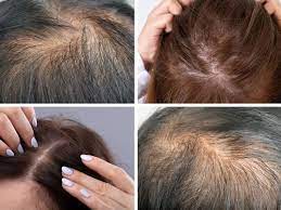 hair thinning causes and cures