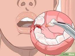 When extracting teeth, a dentist may do the procedure under a local anesthetic mixture injected at each scheduled extraction site or use the technique of a temporary nerve block to take away sensation and pain on one it usually takes gum tissue at the extraction site between three to four weeks to heal. How To Heal Gums After A Tooth Extraction With Pictures