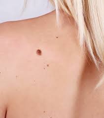 brown spots on the skin advanced