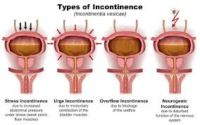 urinary incontinence aare urocare