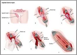 inguinal hernia repair procedure