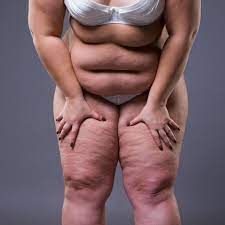 Fat-Shaming: Warum fühlen wir uns von Fetten so provoziert? | STERN.de