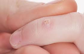 warts in children and agers