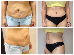'i would not perform a combined bbl and tummy tuck. Exercising After Tummy Tuck Plastic Surgery Institute Atlanta Marietta Georgia