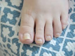 yellow toenails causes prevention