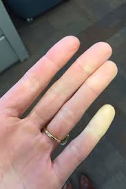 help my fingers turn white in the cold