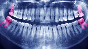 Therefore, coffee after a tooth extraction is not allowed. Wisdom Tooth Extraction Implantcentre Clinique Dentaire Geneve Implants Dentaires A Geneve Suisse