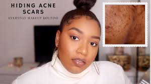 my acne scars