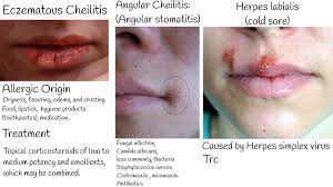 chapped lips lips lesion types