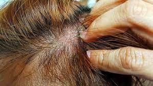 Schuppenflechte, neurodermitis und andere hauterkrankungen reizen das nervensystem der haut dauerhaft. Rote Flecken Und Gerotete Kopfhaut Was Tun