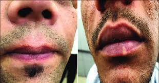 fordyce s spots on upper lip a and