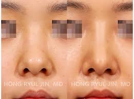 We did not find results for: 1 Shape Of Bulbous Nose Bulbous Nose Has A Wide And Big Nasal Bridge And Tip So Bulbous Nose Rhinoplasty Is T Bulbous Nose Rhinoplasty Rhinoplasty Nose Jobs