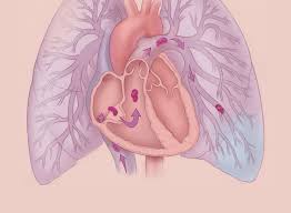 Pulmonary embolism (pe) is a medical emergency. Prehospital Stabilization Of Pulmonary Embolism Ems World