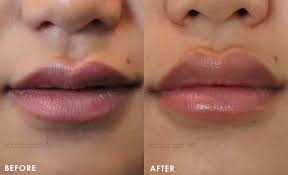 lip augmentation ay cosmetic clinic