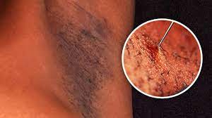 armpits ingrown hair treatment