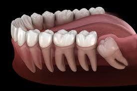 wisdom tooth surgery feel relief with