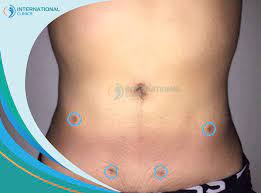 male liposuction scars causes