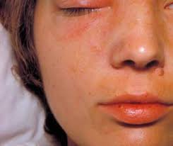 staph infections symptoms causes