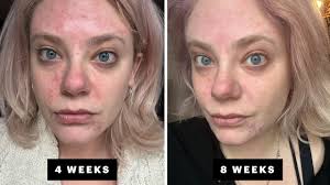 my hormonal acne journey with winlevi