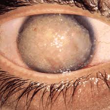 Hereditary cogan microcystic corneal dystrophy is sometimes diagnosed in the first decade of life but more many individuals with some findings of microcystic dystrophy have no family history of the disease and, as. Corneal Dystrophy Wikipedia