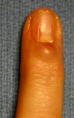 fingertip ganglion cysts mucous cysts
