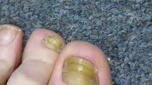 my toenail fungus sucess story you