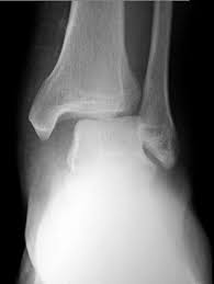 Maisonneuve fractures are a result of external rotation of a planted foot, most often with pronation of the foot. Maisonneuve Fracture Radiology Case Radiopaedia Org