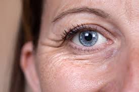 non surgical hooded eyes treatment in
