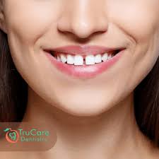 teeth midline shift trucare dentistry