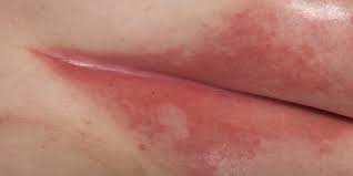 Intertrigo is an inflammatory skin condition of skin folds exposed to friction or maceration in the presence of heat and moisture. Intertrigo Infections Apex Dermatology Skin Surgery