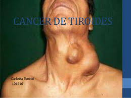 El cáncer de tiroides anaplásico es difícil de curar con los tratamientos vigentes; Cancer De Tiroides