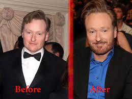 Conan o'brien's plastic surgery happened after he was attacked while still at school. Conan O Brien Stole My Look Now My Music