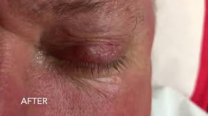 wart removal on the eyelid