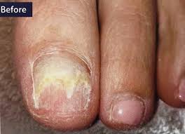 pedique cosmetic toenail replacement