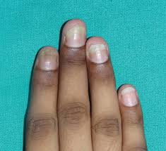 nail diseases in women springerlink