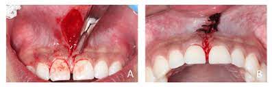 upper l frenectomy a surgical
