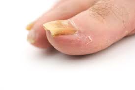 painful thickened toenails mackay