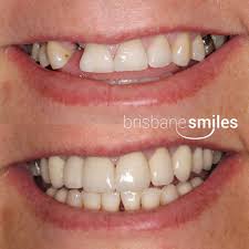 dental implant costs dental implants