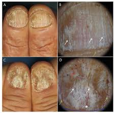 inflammatory nail disorders