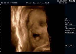 In der frühschwangerschaft, etwa zwischen der 8. 3d 4d Ultraschall Frauenarzt Saarlouis Dr Daub